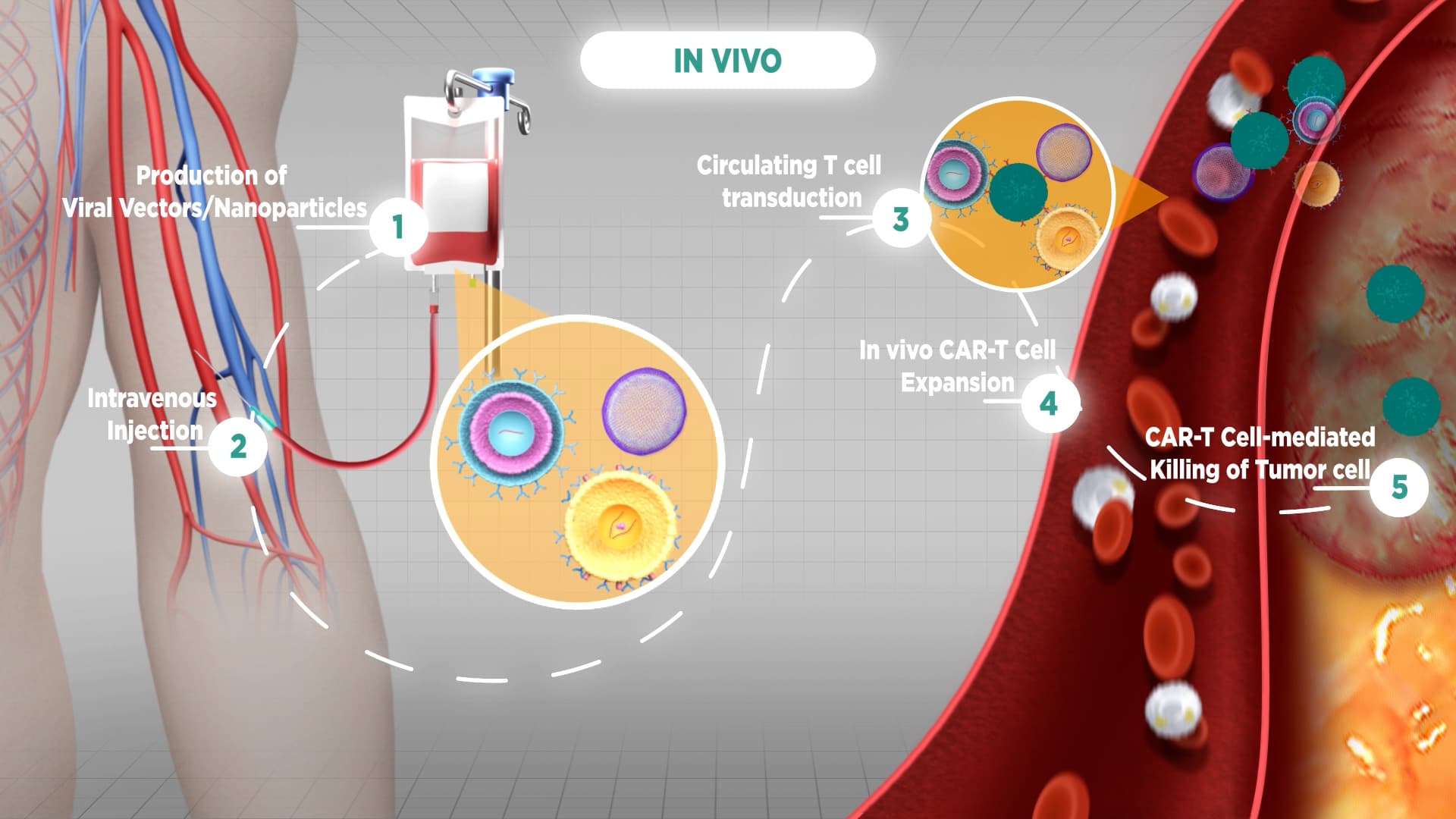 Animated schematic of in vivo CAR-T cell therapy showing viral vector delivery, T cell transduction in the bloodstream, and tumor killing in 5 steps
