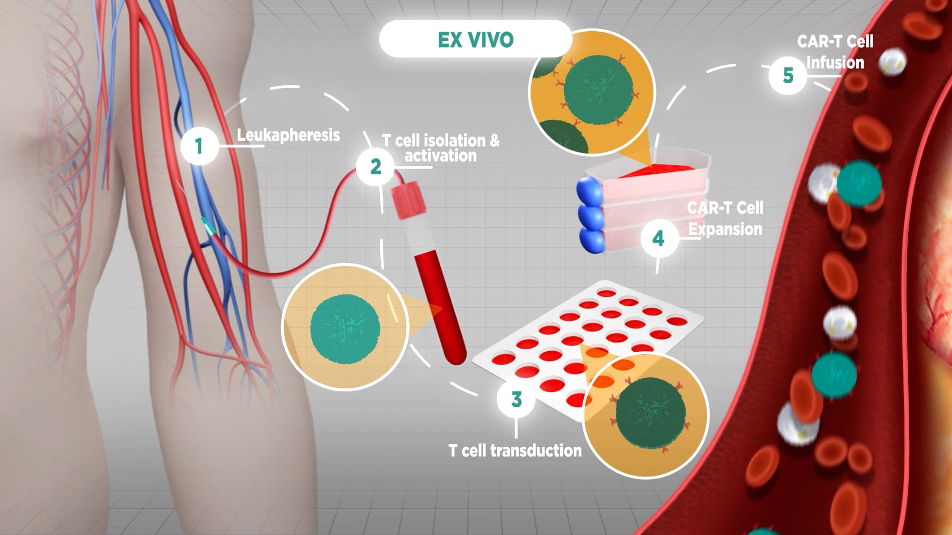 Animated schematic of ex vivo CAR-T cell therapy showing leukapheresis, T cell isolation, viral transduction, expansion, and reinfusion in 5 steps