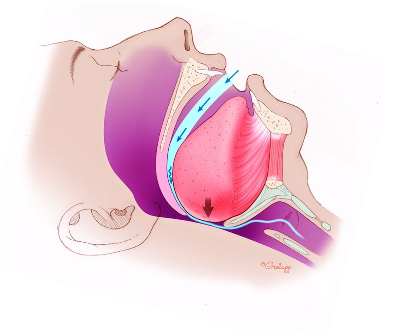 Obstructive Sleep apnea
