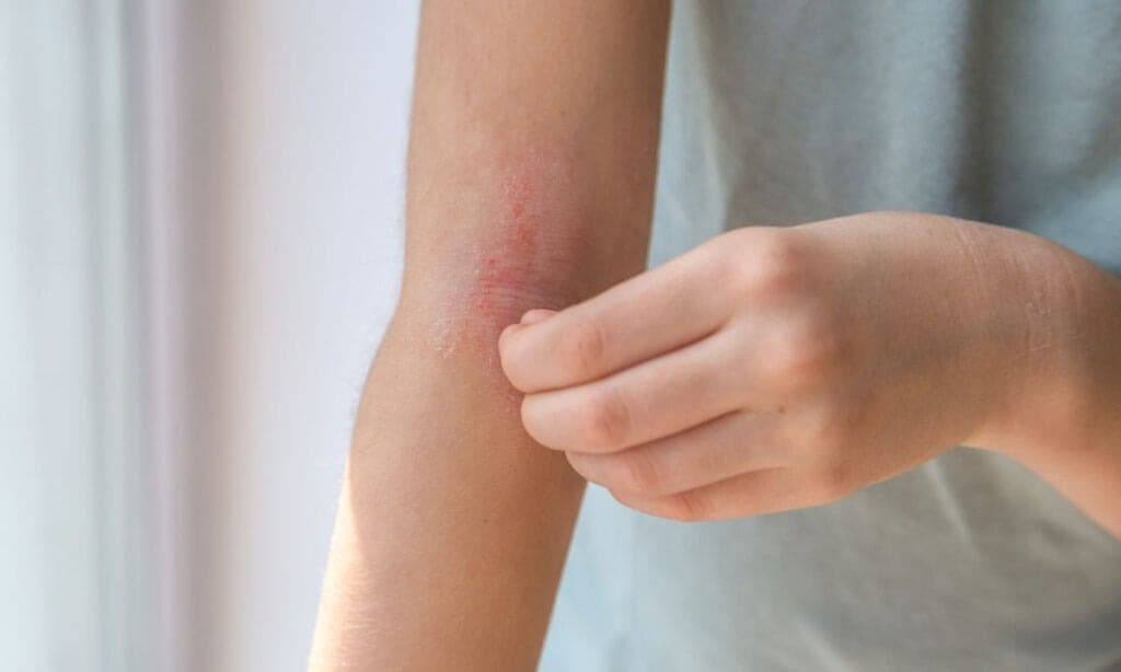 Person scratching an itchy, irritated arm.